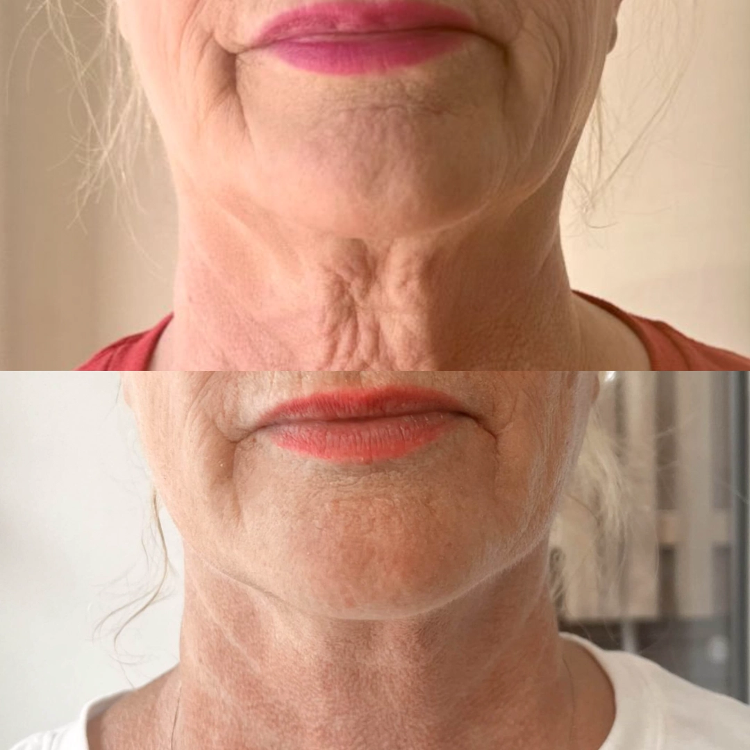 Sofwave™ 8 Lower Face_Neck_1