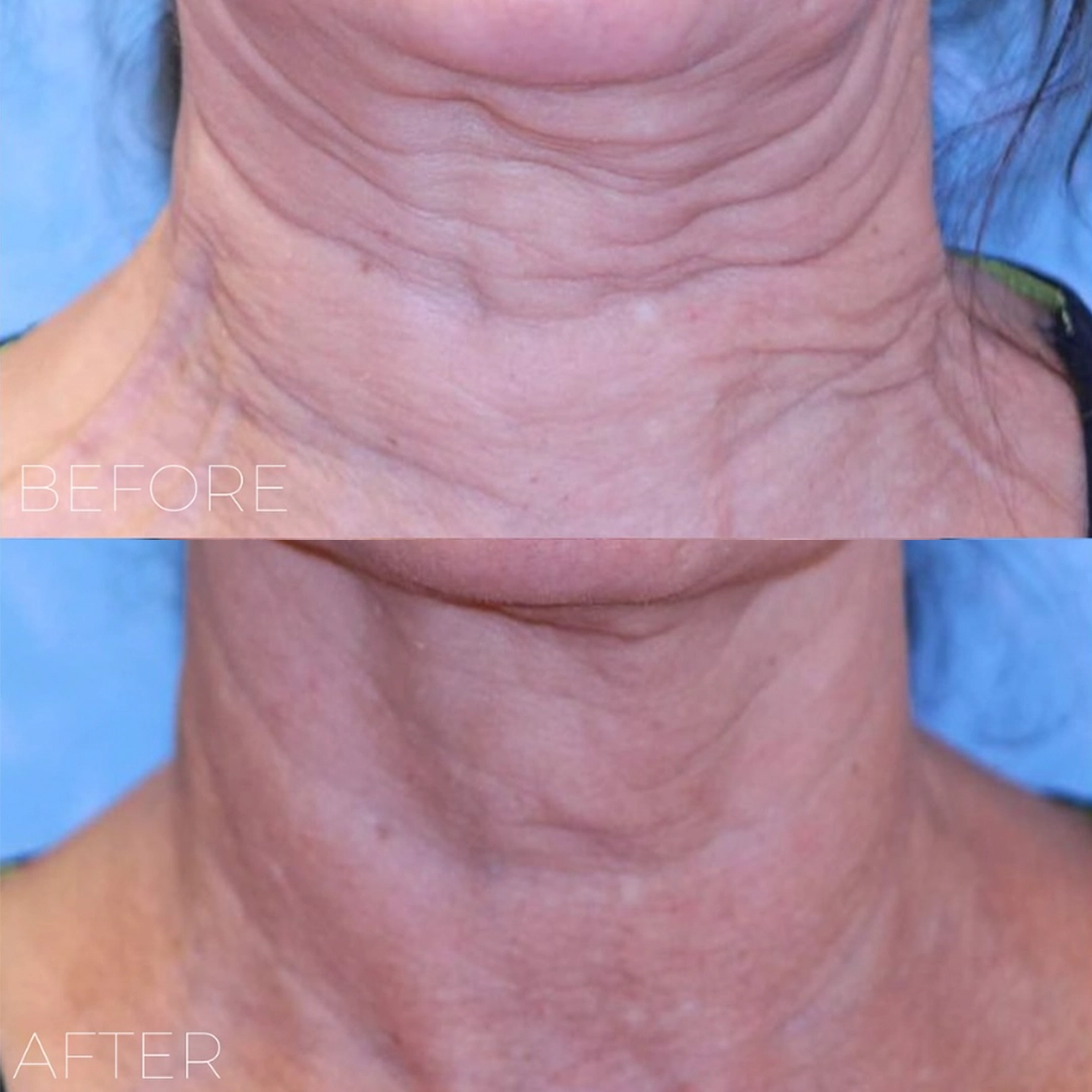 Sofwave™ 10 Neck_2