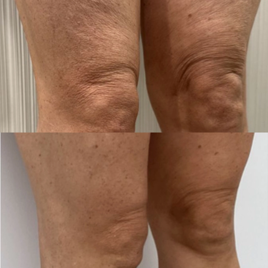 Sofwave™ 15 Thigh_1